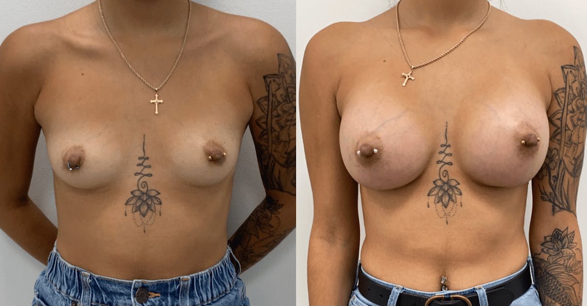 Breast Augmentation Before & After Gallery - Patient 113155 - Image 1