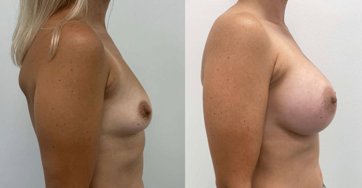 Breast Augmentation Before & After Gallery - Patient 375381 - Image 1