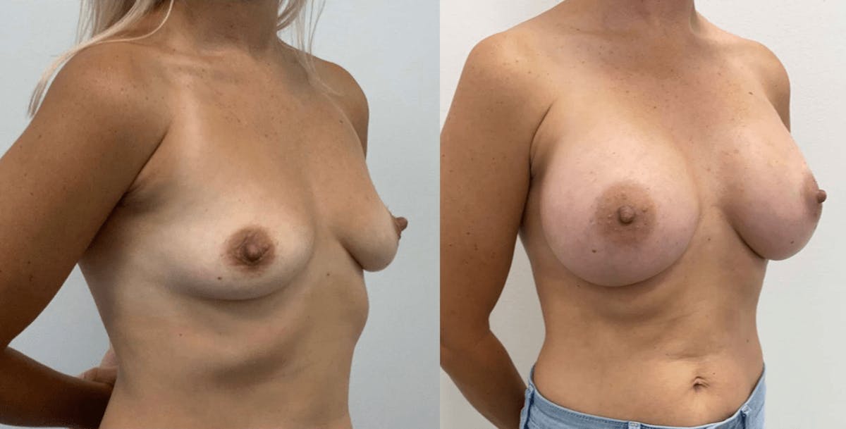 Breast Augmentation Before & After Gallery - Patient 375381 - Image 2