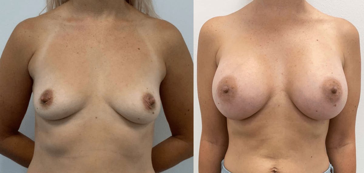 Breast Augmentation Before & After Gallery - Patient 375381 - Image 3