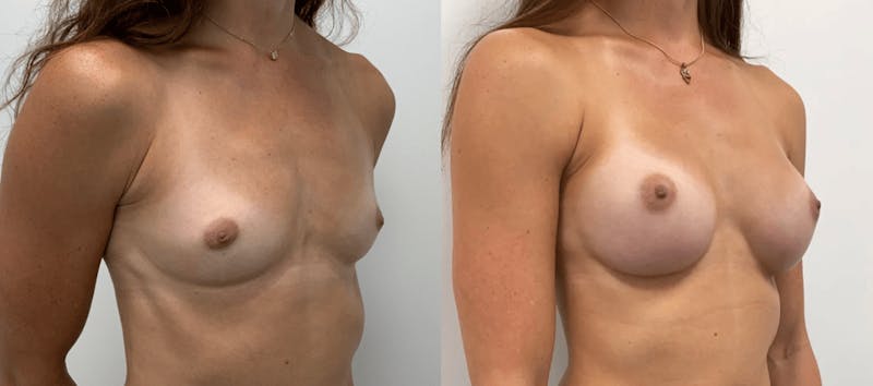 Breast Augmentation Before & After Gallery - Patient 532733 - Image 1