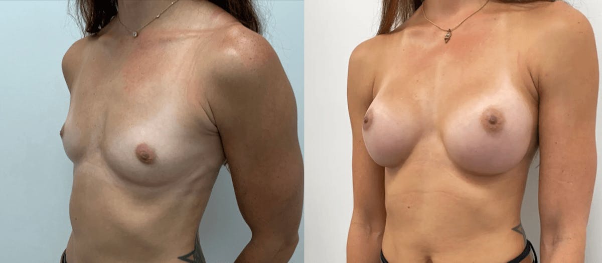 Breast Augmentation Before & After Gallery - Patient 532733 - Image 2