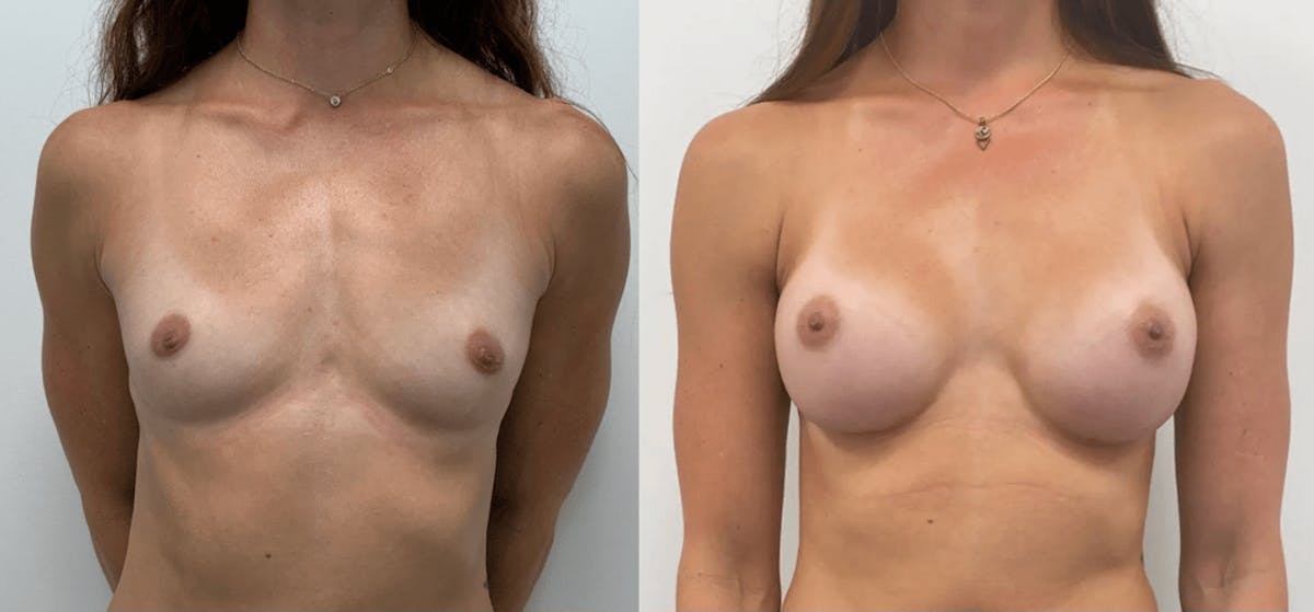 Breast Augmentation Before & After Gallery - Patient 532733 - Image 3