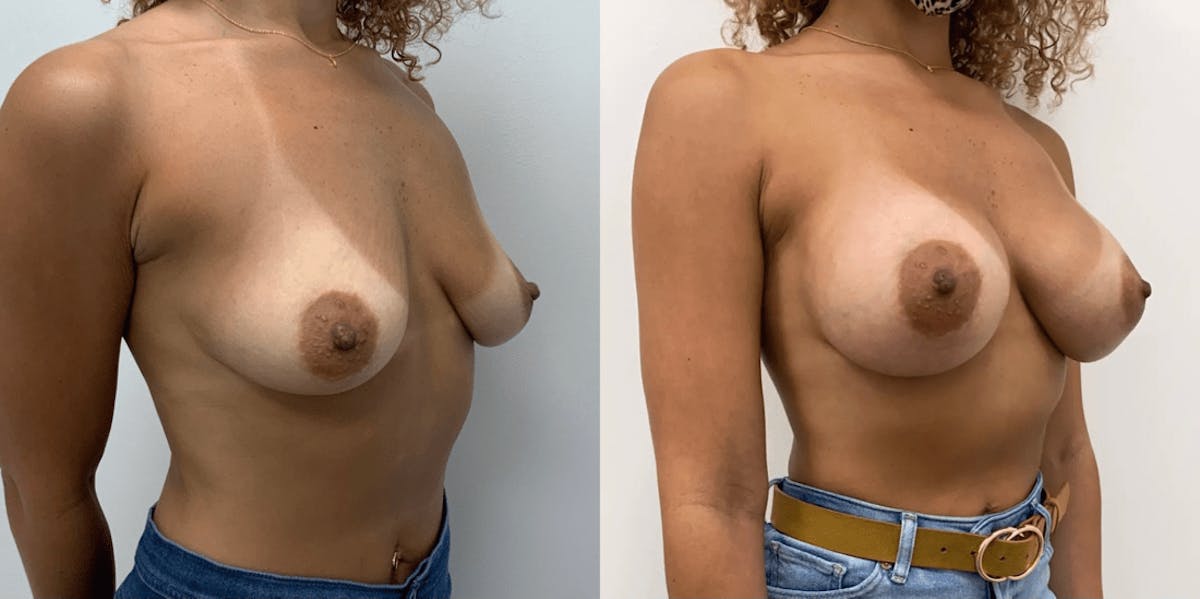 Breast Augmentation Before & After Gallery - Patient 654678 - Image 1