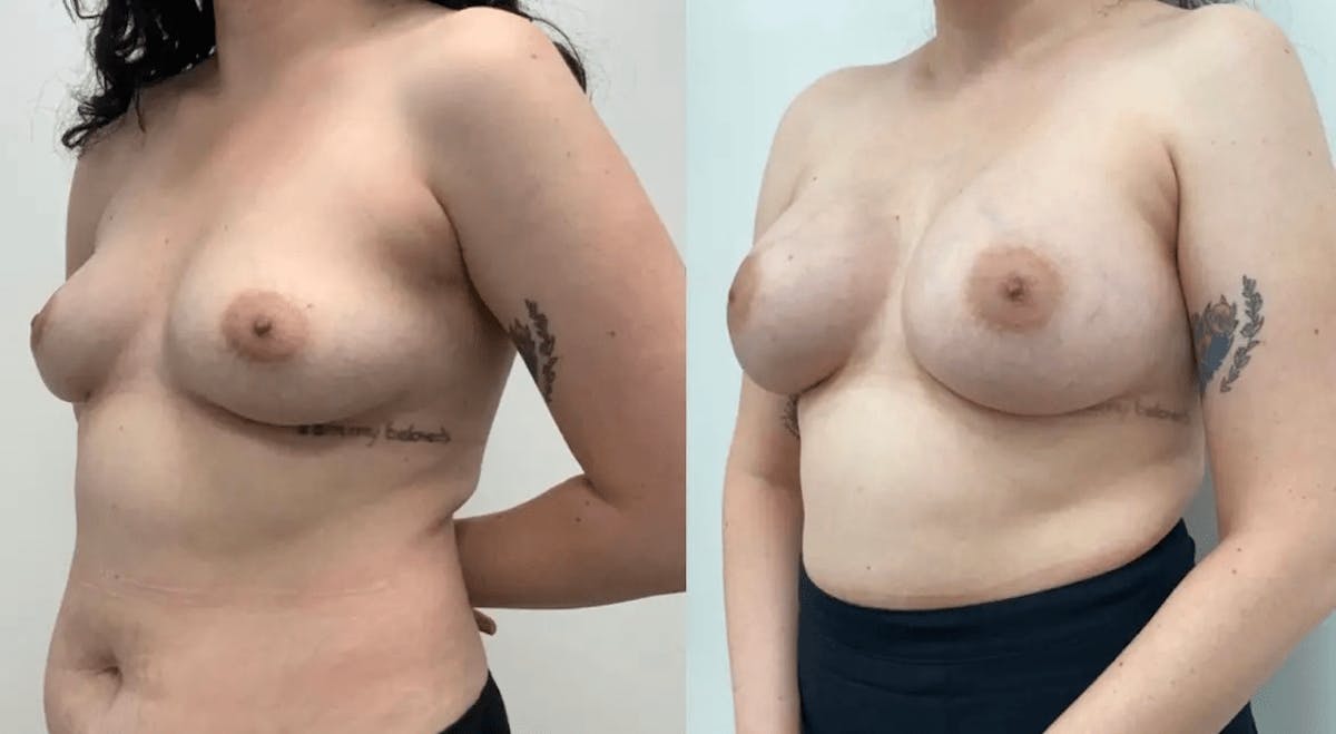 Breast Augmentation Before & After Gallery - Patient 167935 - Image 1