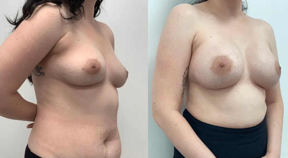 Breast Augmentation Before & After Gallery - Patient 167935 - Image 2