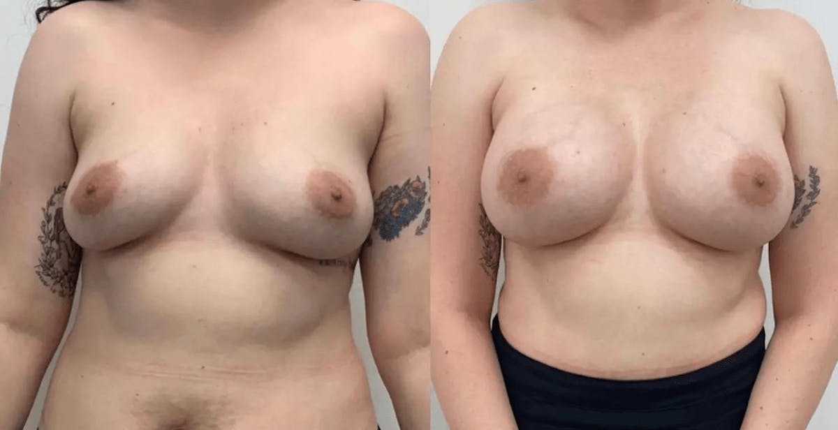 Breast Augmentation Before & After Gallery - Patient 167935 - Image 3