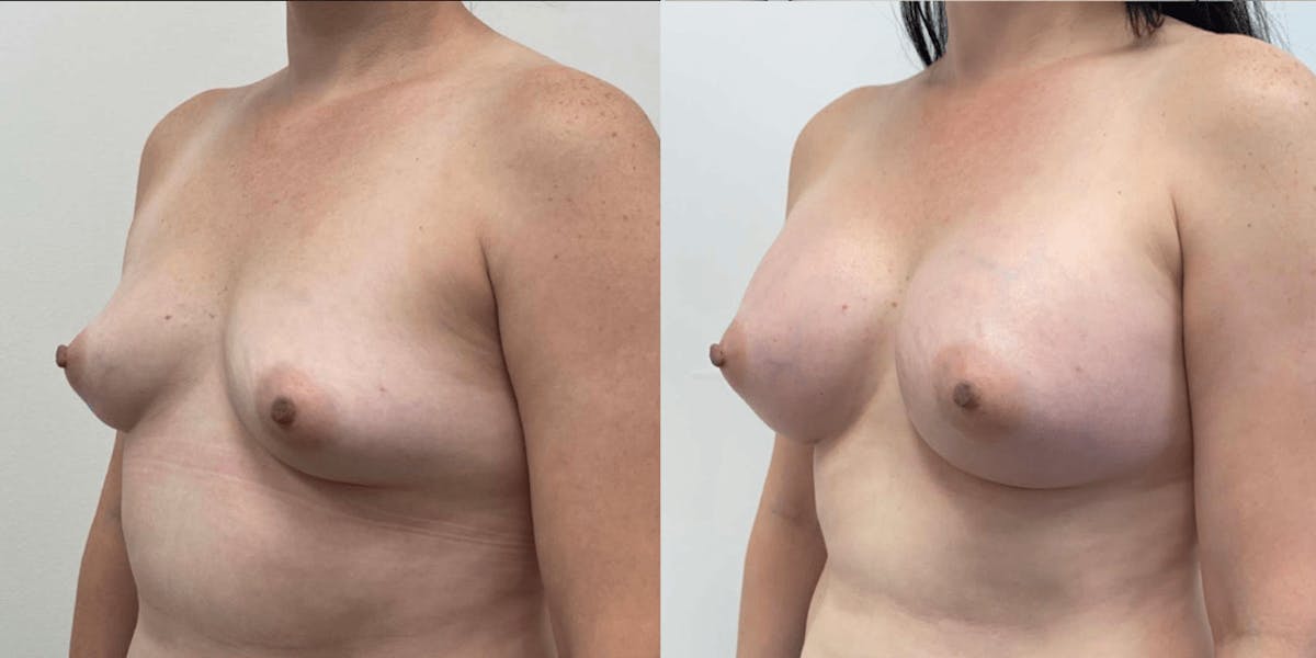 Breast Augmentation Before & After Gallery - Patient 603055 - Image 1