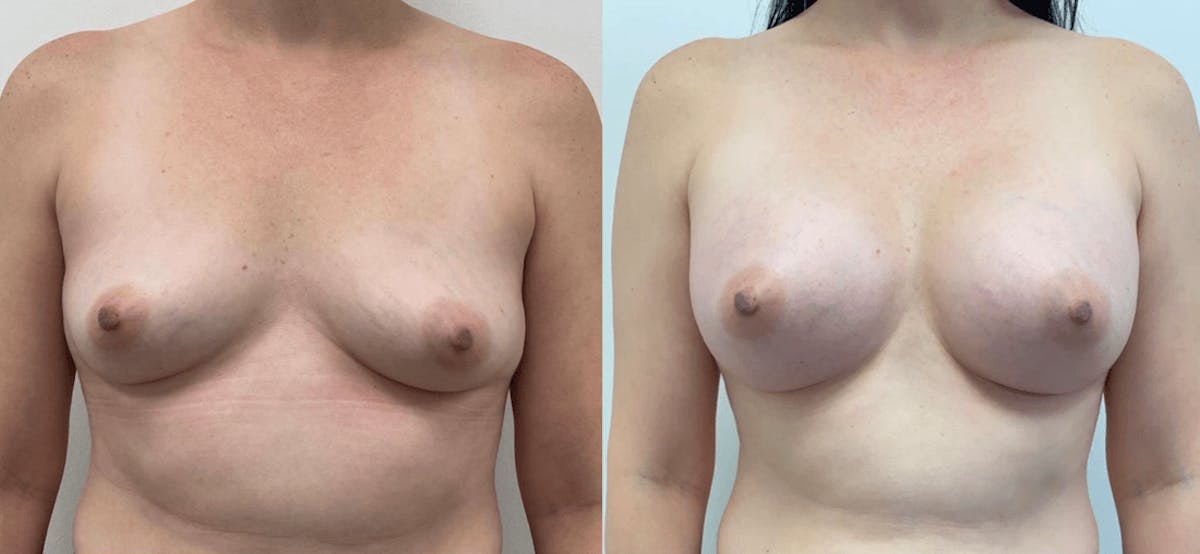 Breast Augmentation Before & After Gallery - Patient 603055 - Image 2