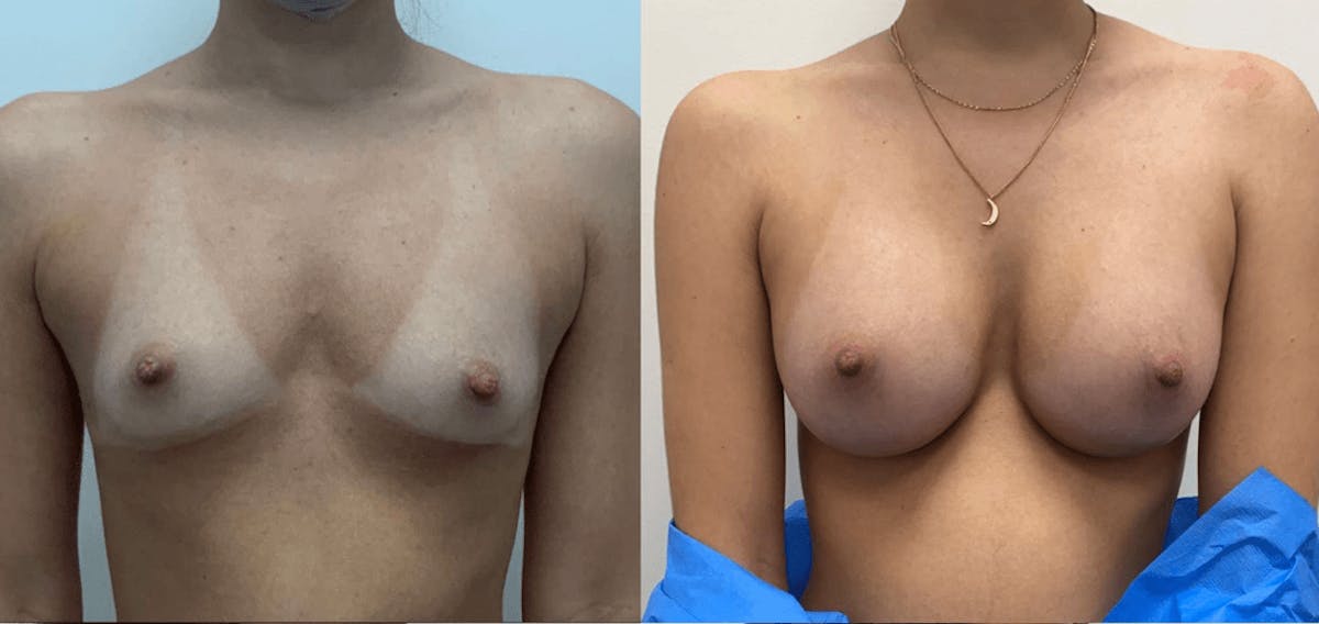 Breast Augmentation Before & After Gallery - Patient 233821 - Image 1