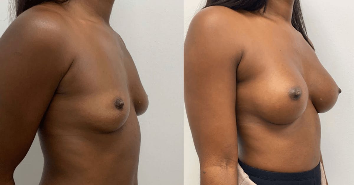 Breast Augmentation Before & After Gallery - Patient 296366 - Image 1
