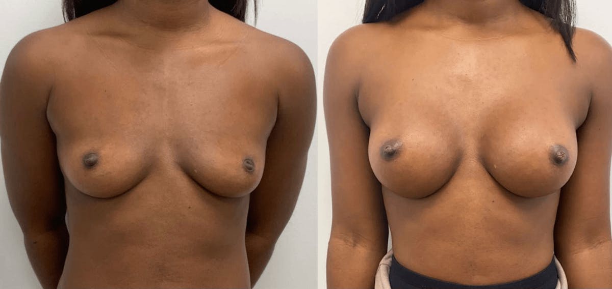 Breast Augmentation Before & After Gallery - Patient 296366 - Image 2