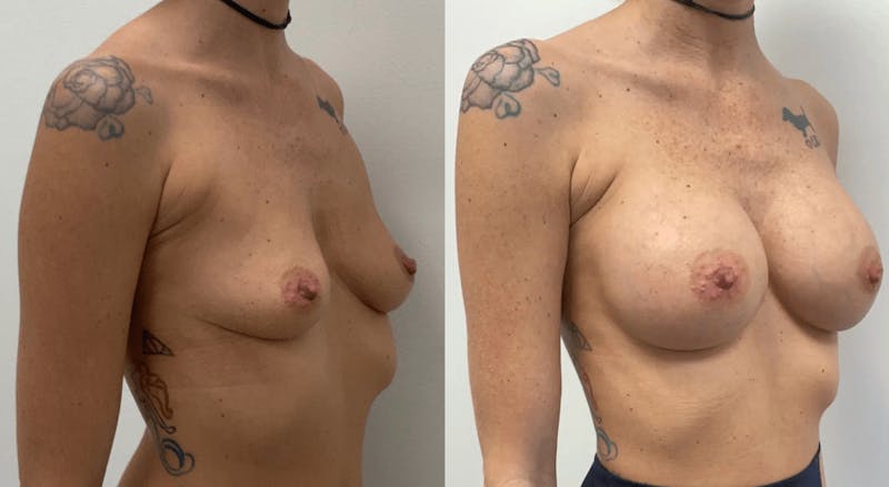Breast Augmentation Before & After Gallery - Patient 161639 - Image 1