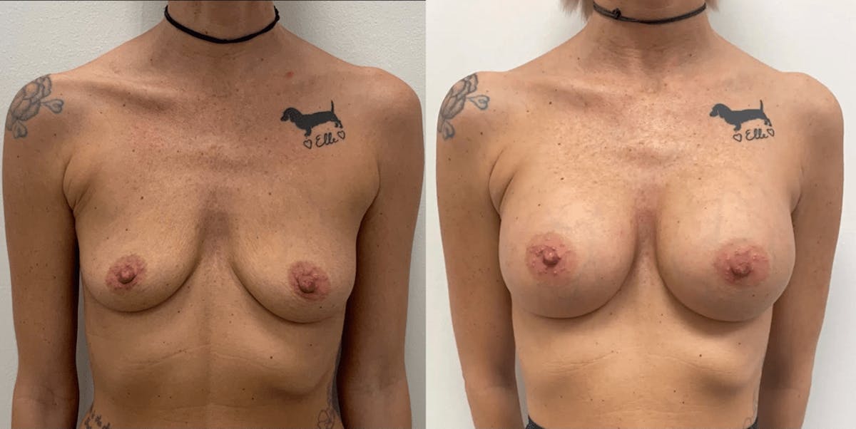 Breast Augmentation Before & After Gallery - Patient 161639 - Image 2