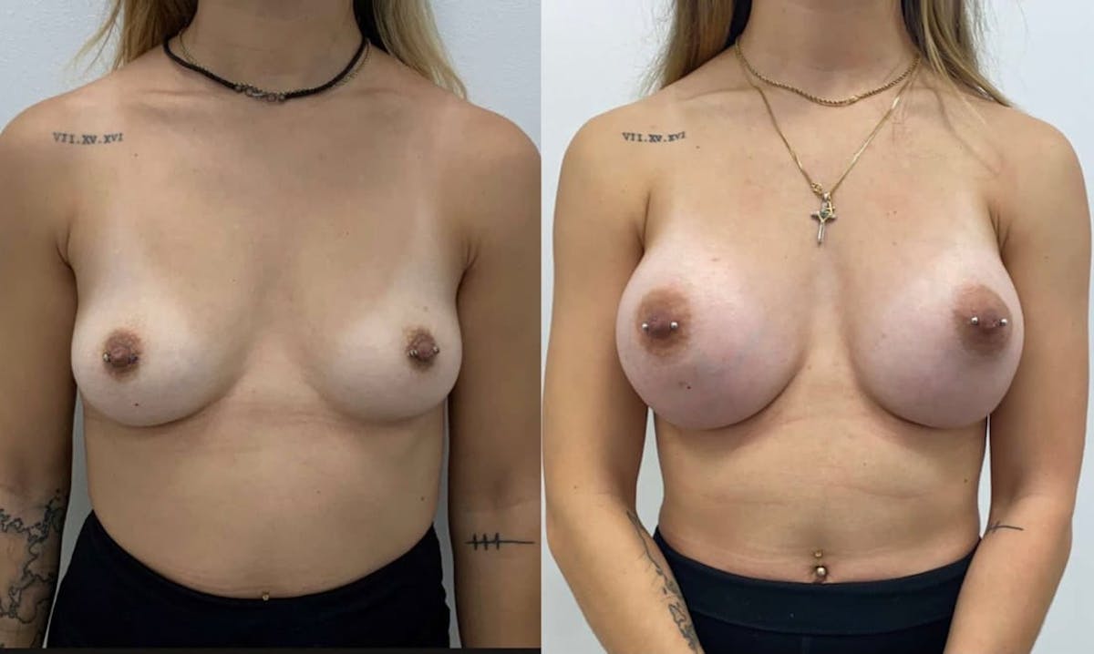 Breast Augmentation Before & After Gallery - Patient 113766 - Image 1