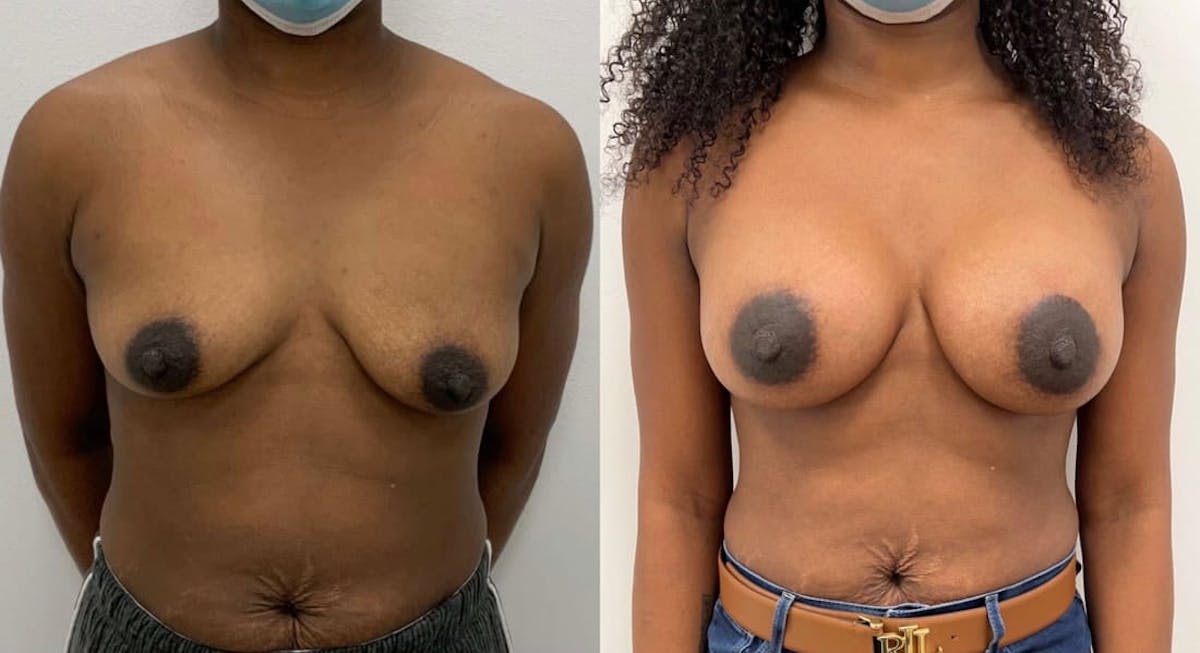 Breast Augmentation Before & After Gallery - Patient 388885 - Image 1