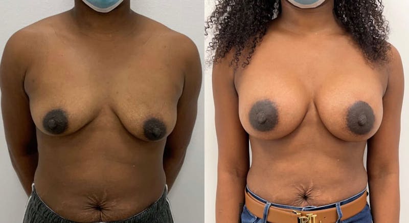 Breast Augmentation Before & After Gallery - Patient 388885 - Image 1