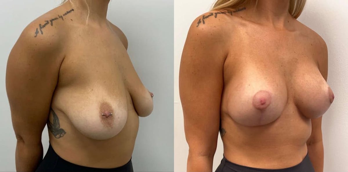 Breast Augmentation Before & After Gallery - Patient 256310 - Image 1