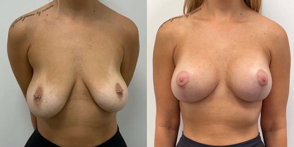 Breast Augmentation Before & After Gallery - Patient 256310 - Image 2