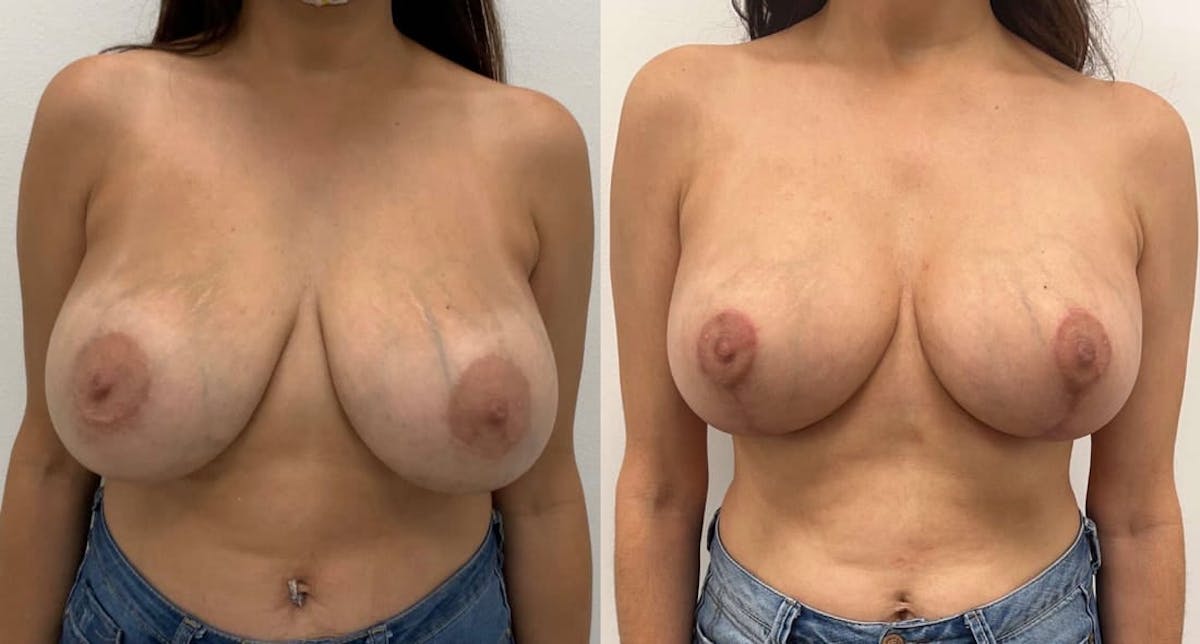 Breast Augmentation Before & After Gallery - Patient 420124 - Image 1