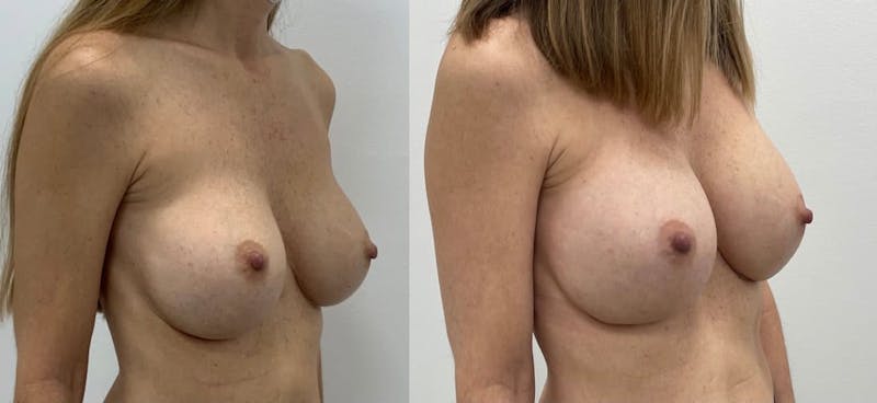 Breast Augmentation Before & After Gallery - Patient 270281 - Image 1