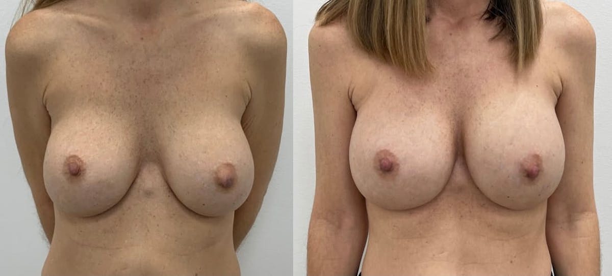 Breast Augmentation Before & After Gallery - Patient 270281 - Image 2