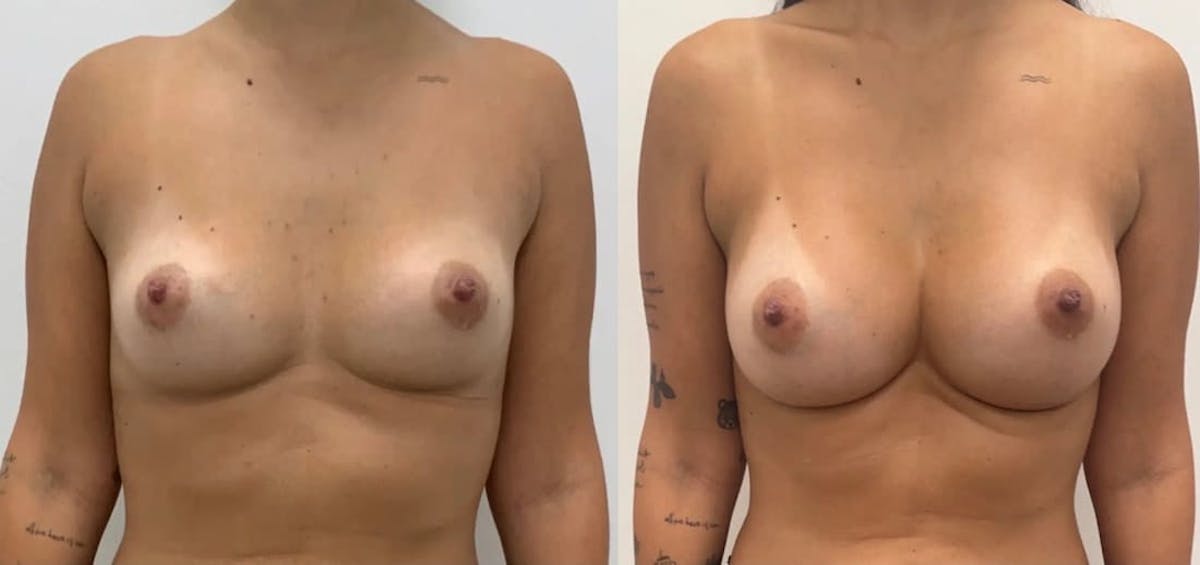 Breast Augmentation Before & After Gallery - Patient 182148 - Image 1