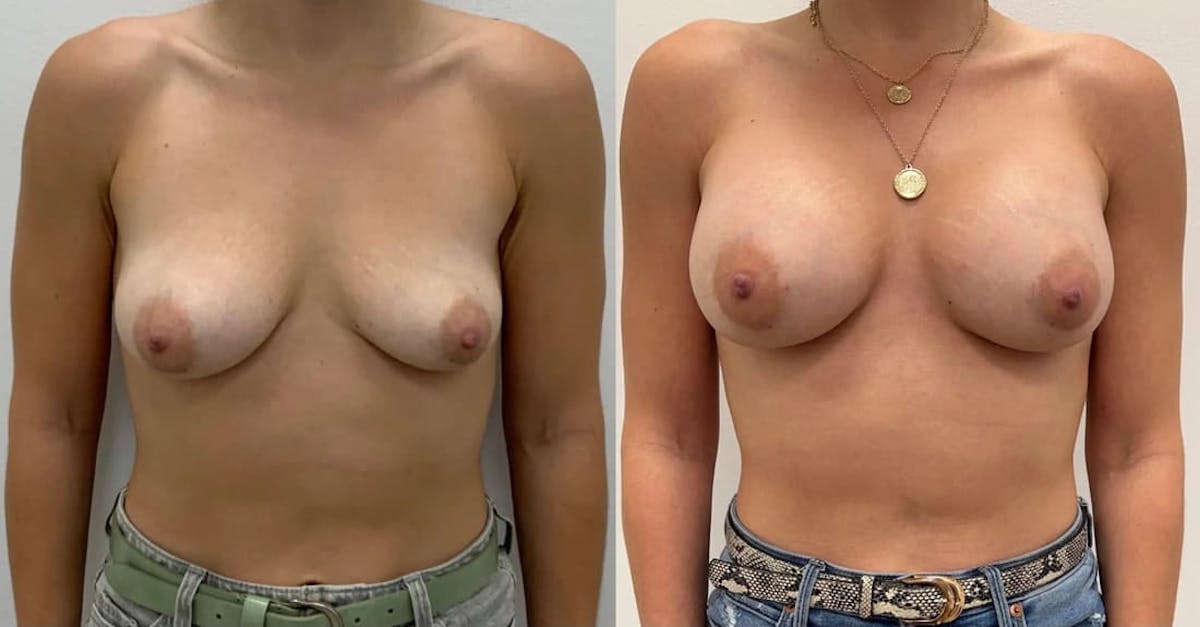 Breast Augmentation Before & After Gallery - Patient 320049 - Image 2