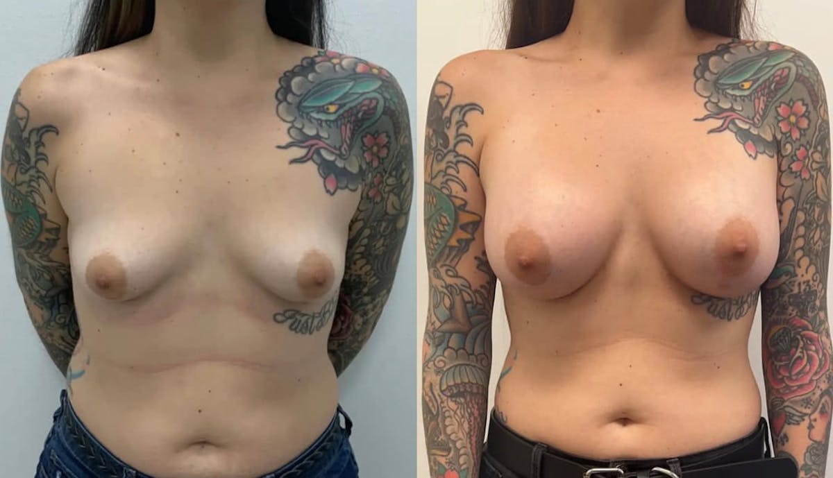 Breast Augmentation Before & After Gallery - Patient 108903 - Image 1