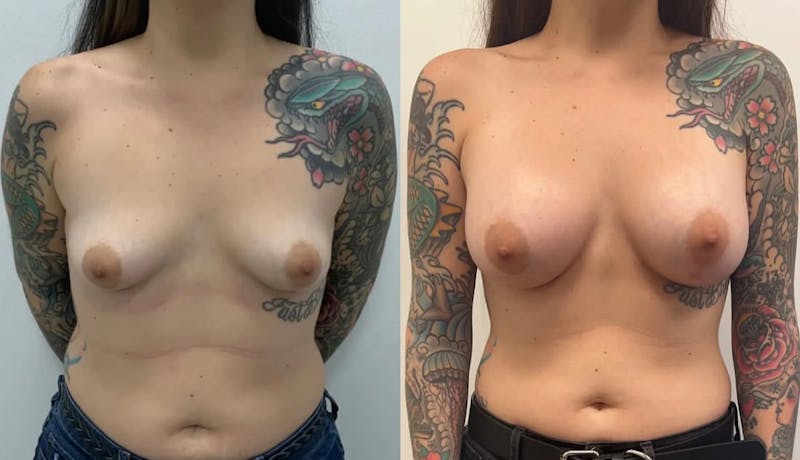 Breast Augmentation Before & After Gallery - Patient 108903 - Image 1