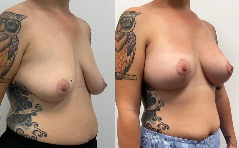 Breast Augmentation Before & After Gallery - Patient 188536 - Image 1
