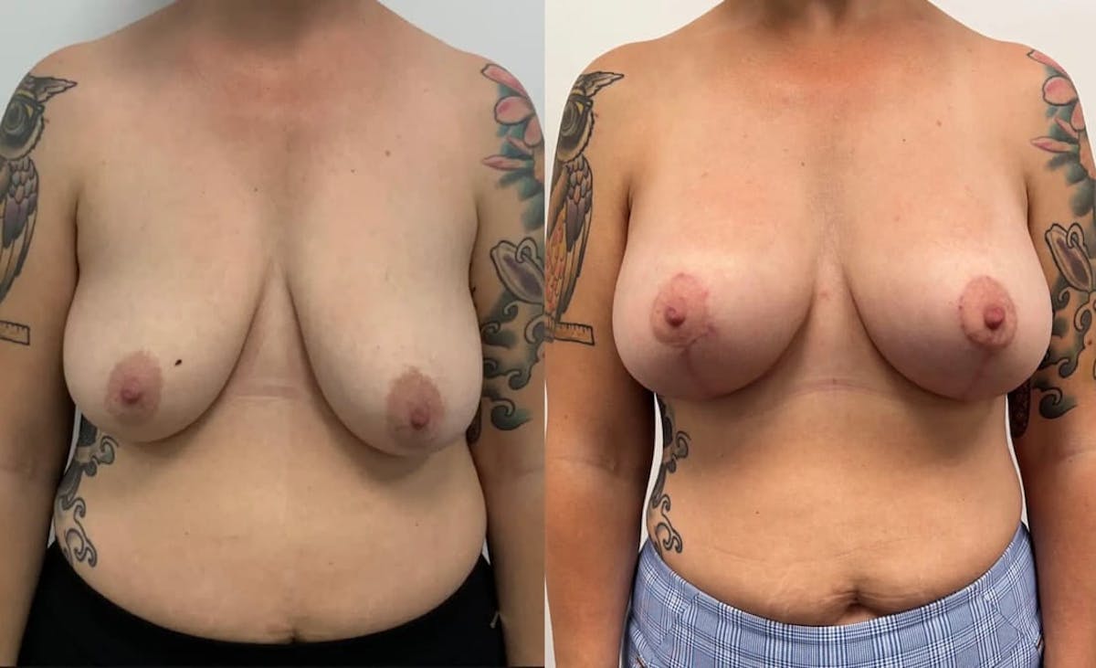 Breast Augmentation Before & After Gallery - Patient 188536 - Image 2