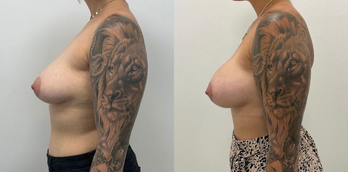 Breast Augmentation Before & After Gallery - Patient 316142 - Image 1