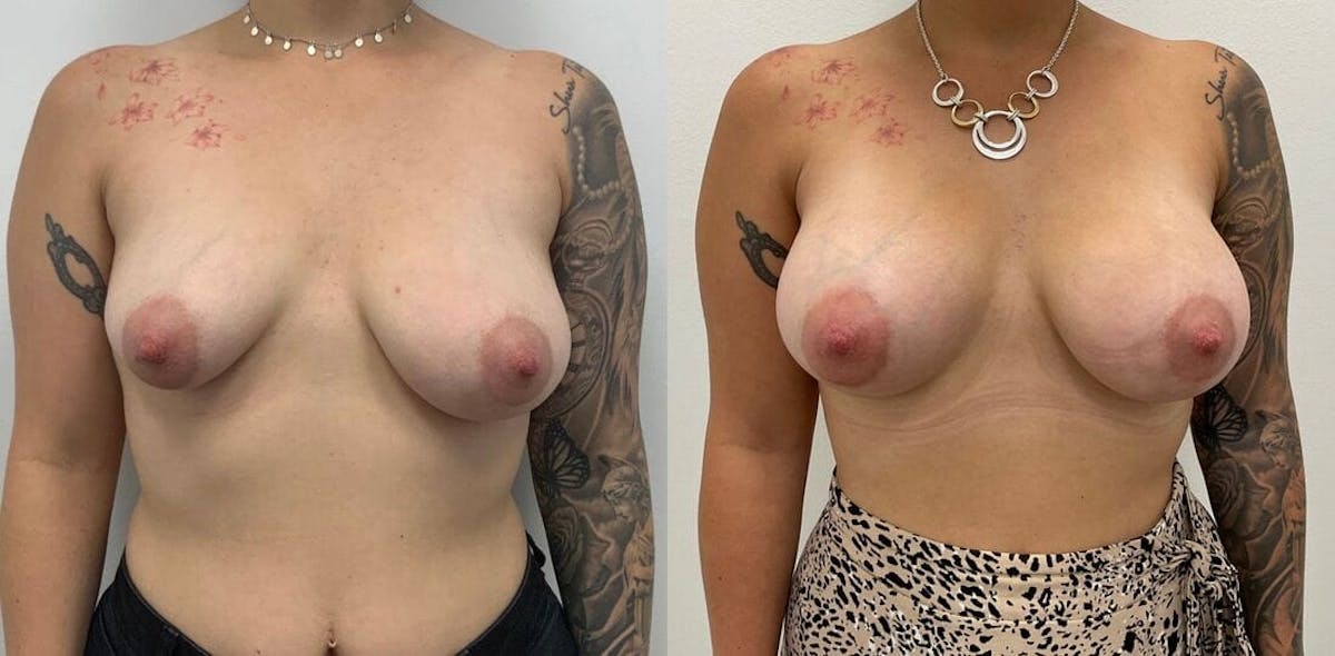 Breast Augmentation Before & After Gallery - Patient 316142 - Image 2