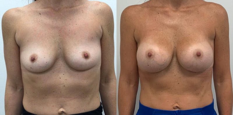 Breast Augmentation Before & After Gallery - Patient 413613 - Image 1