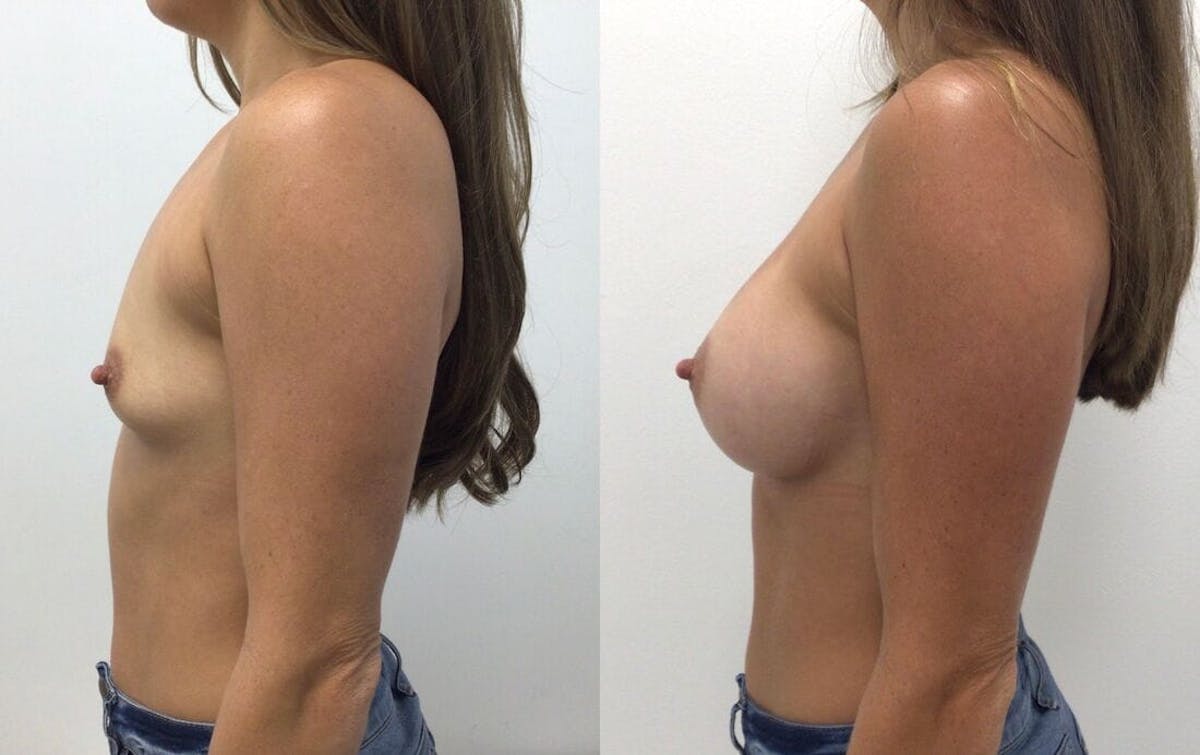 Breast Augmentation Before & After Gallery - Patient 168418 - Image 2