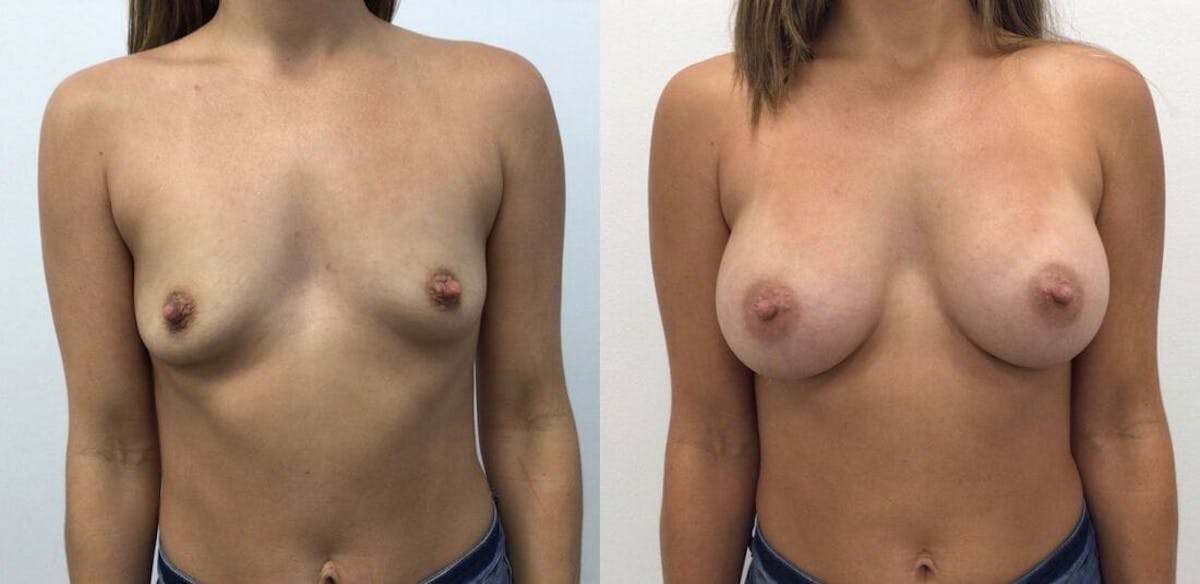 Breast Augmentation Before & After Gallery - Patient 168418 - Image 1