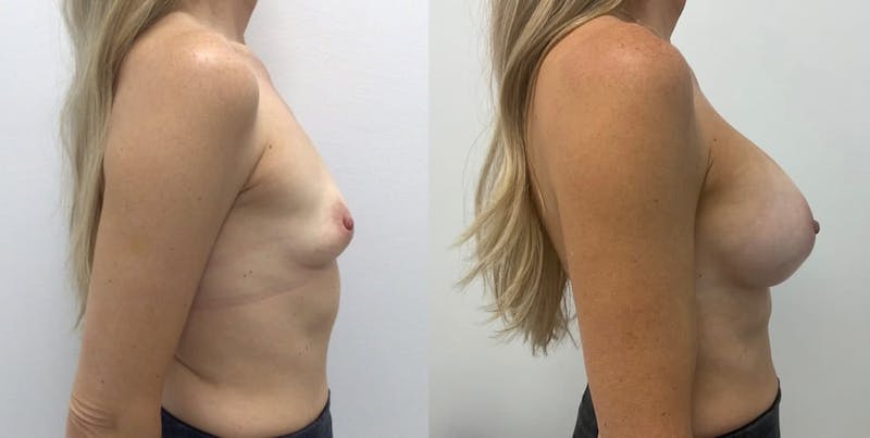 Breast Augmentation Before & After Gallery - Patient 134970 - Image 1