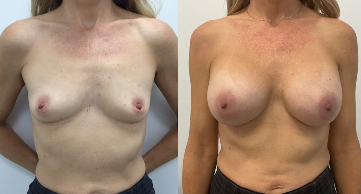 Breast Augmentation Before & After Gallery - Patient 134970 - Image 2