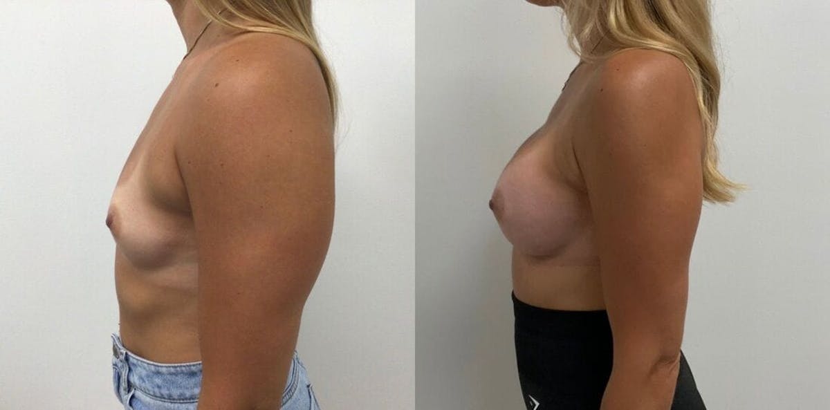 Breast Augmentation Before & After Gallery - Patient 122752 - Image 1