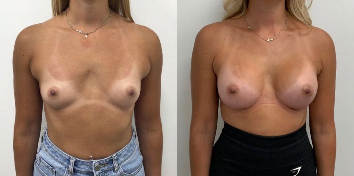 Breast Augmentation Before & After Gallery - Patient 122752 - Image 2
