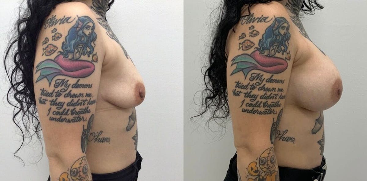 Breast Augmentation Before & After Gallery - Patient 223008 - Image 1