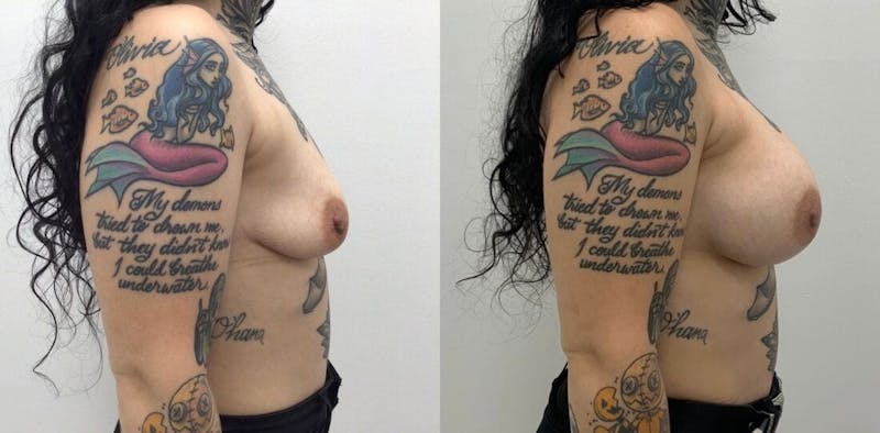 Breast Augmentation Before & After Gallery - Patient 223008 - Image 1
