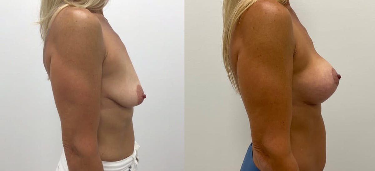 Breast Augmentation Before & After Gallery - Patient 265671 - Image 1