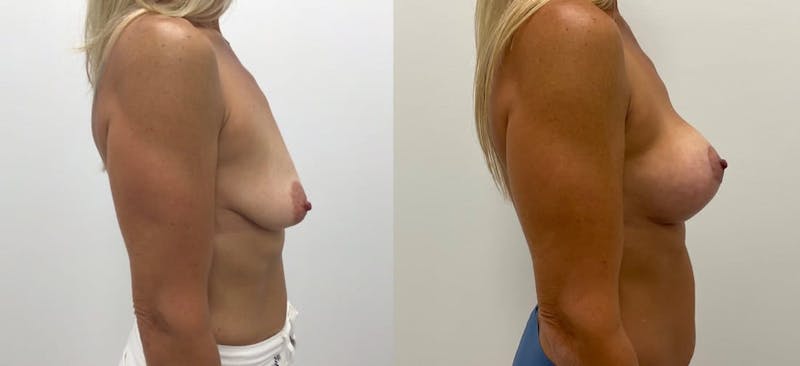 Breast Augmentation Before & After Gallery - Patient 265671 - Image 1