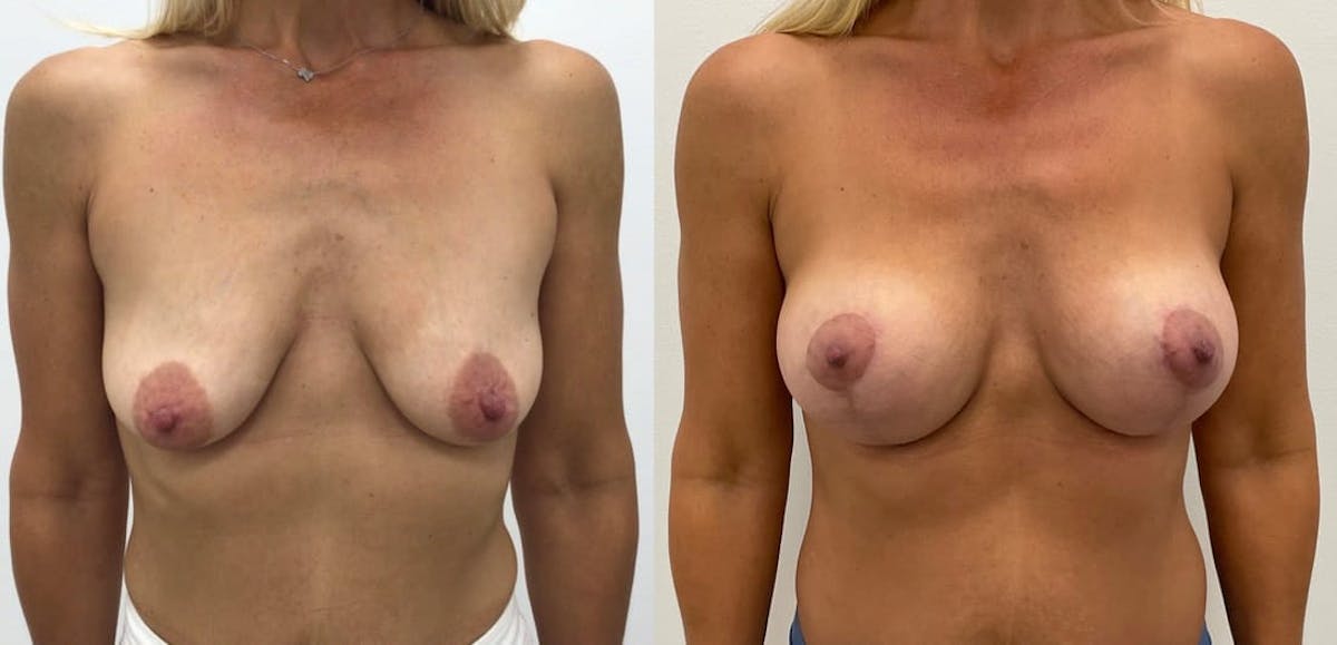 Breast Augmentation Before & After Gallery - Patient 265671 - Image 2