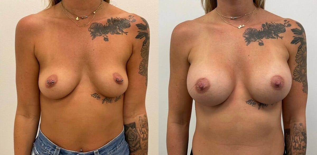 Breast Augmentation Before & After Gallery - Patient 407512 - Image 1