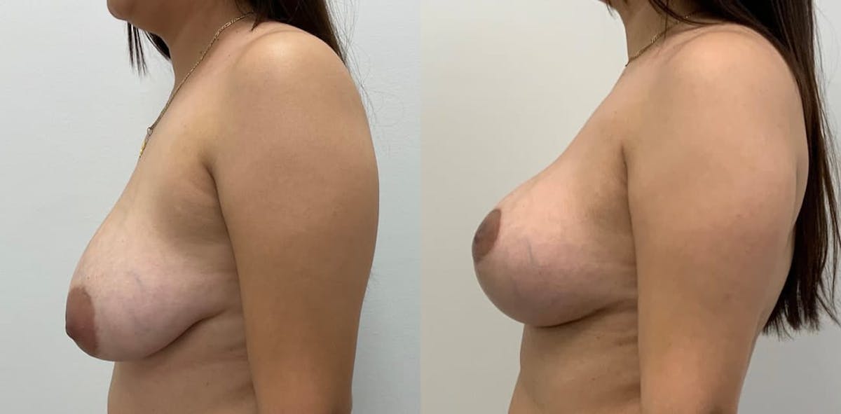 Breast Augmentation Before & After Gallery - Patient 745504 - Image 2