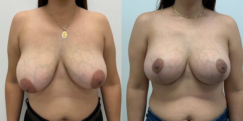 Breast Augmentation Before & After Gallery - Patient 745504 - Image 1
