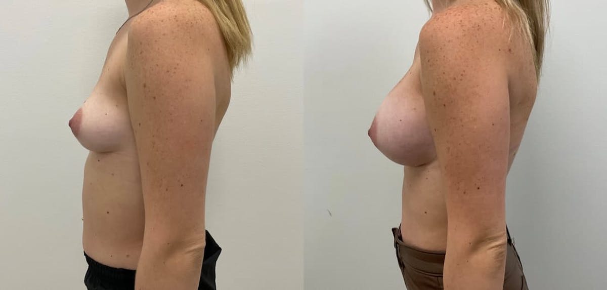 Breast Augmentation Before & After Gallery - Patient 427553 - Image 2